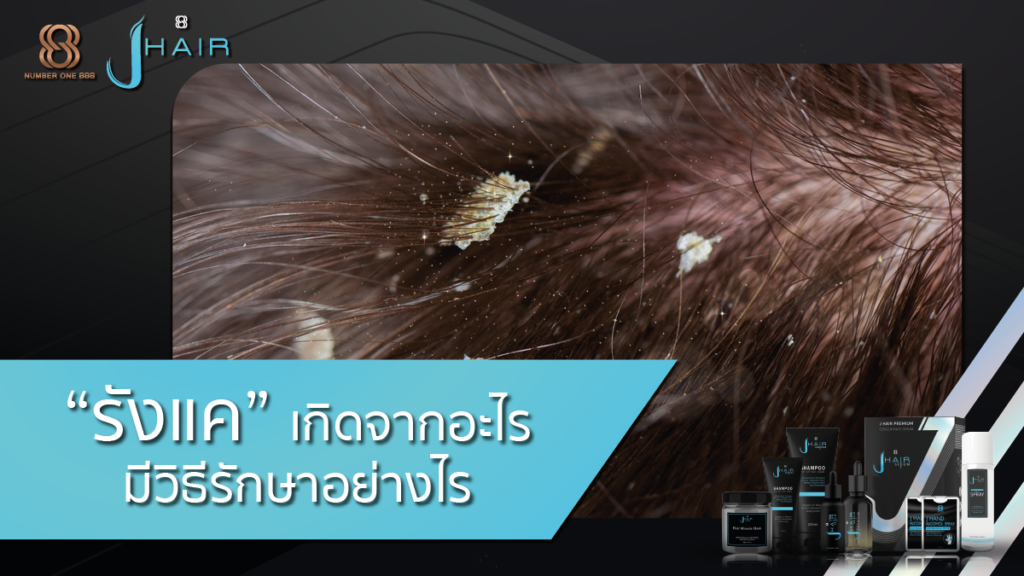 รังแค-วิธีรักษารังแค-รังแคเกิดจากอะไร-Jhair Serum