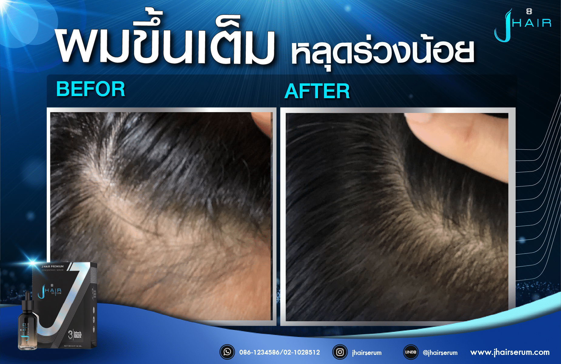 รีวิวจากผู้ใช้จริง J HAIR SERUM เซรั่มปลูกผม