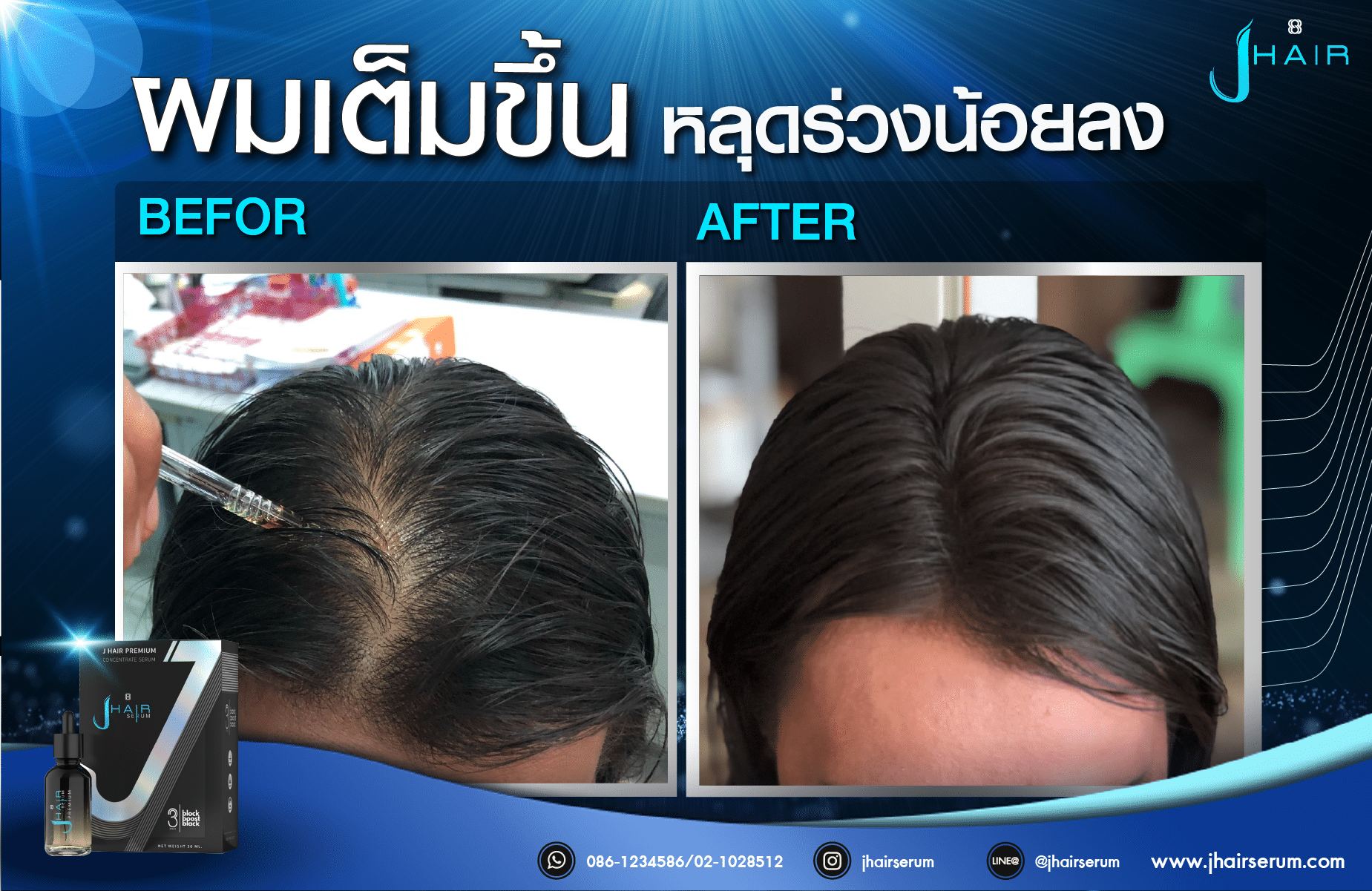 รีวิวจากผู้ใช้จริง J HAIR SERUM เซรั่มปลูกผม