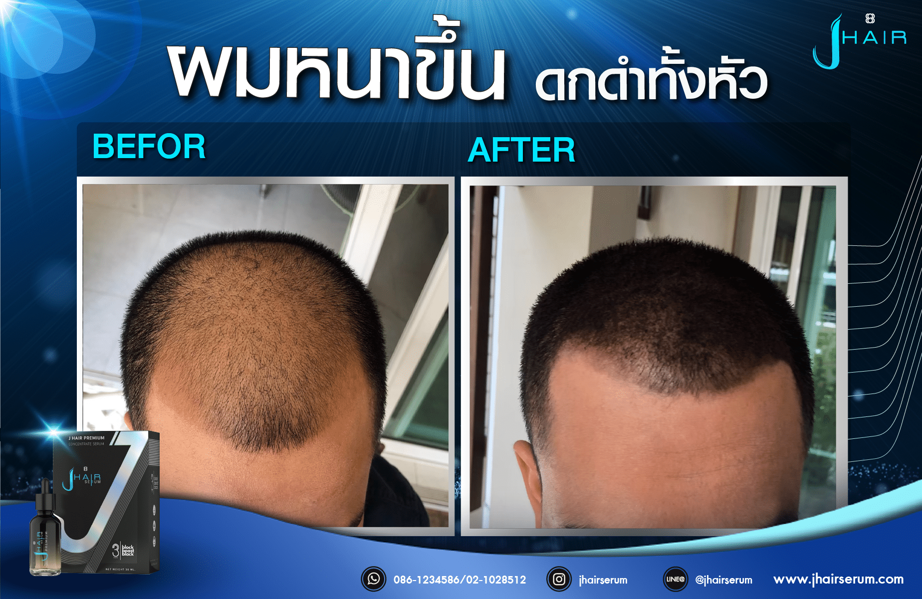รีวิวจากผู้ใช้จริง J HAIR SERUM เซรั่มปลูกผม