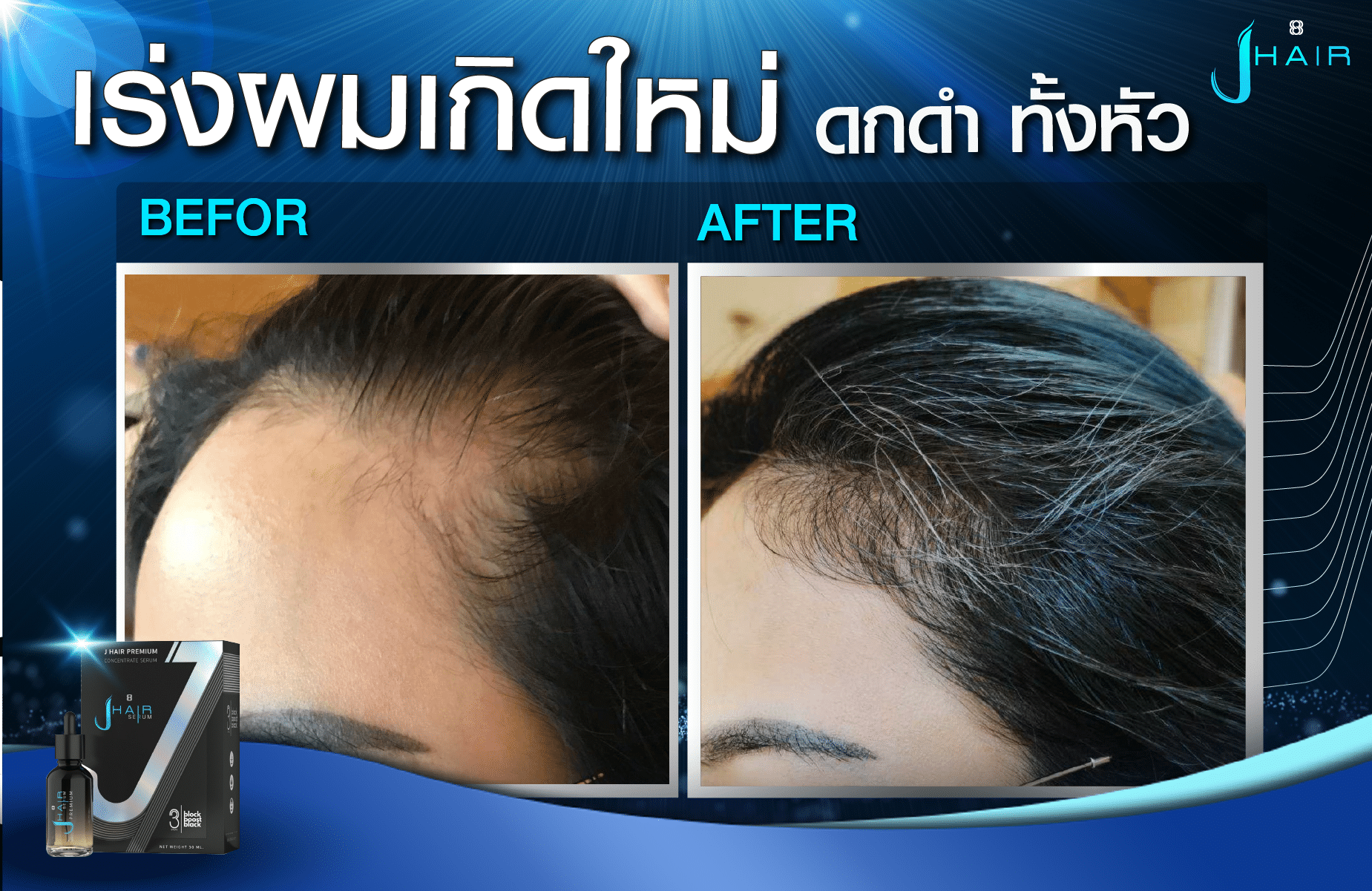 รีวิวจากผู้ใช้จริง J HAIR SERUM เซรั่มปลูกผม