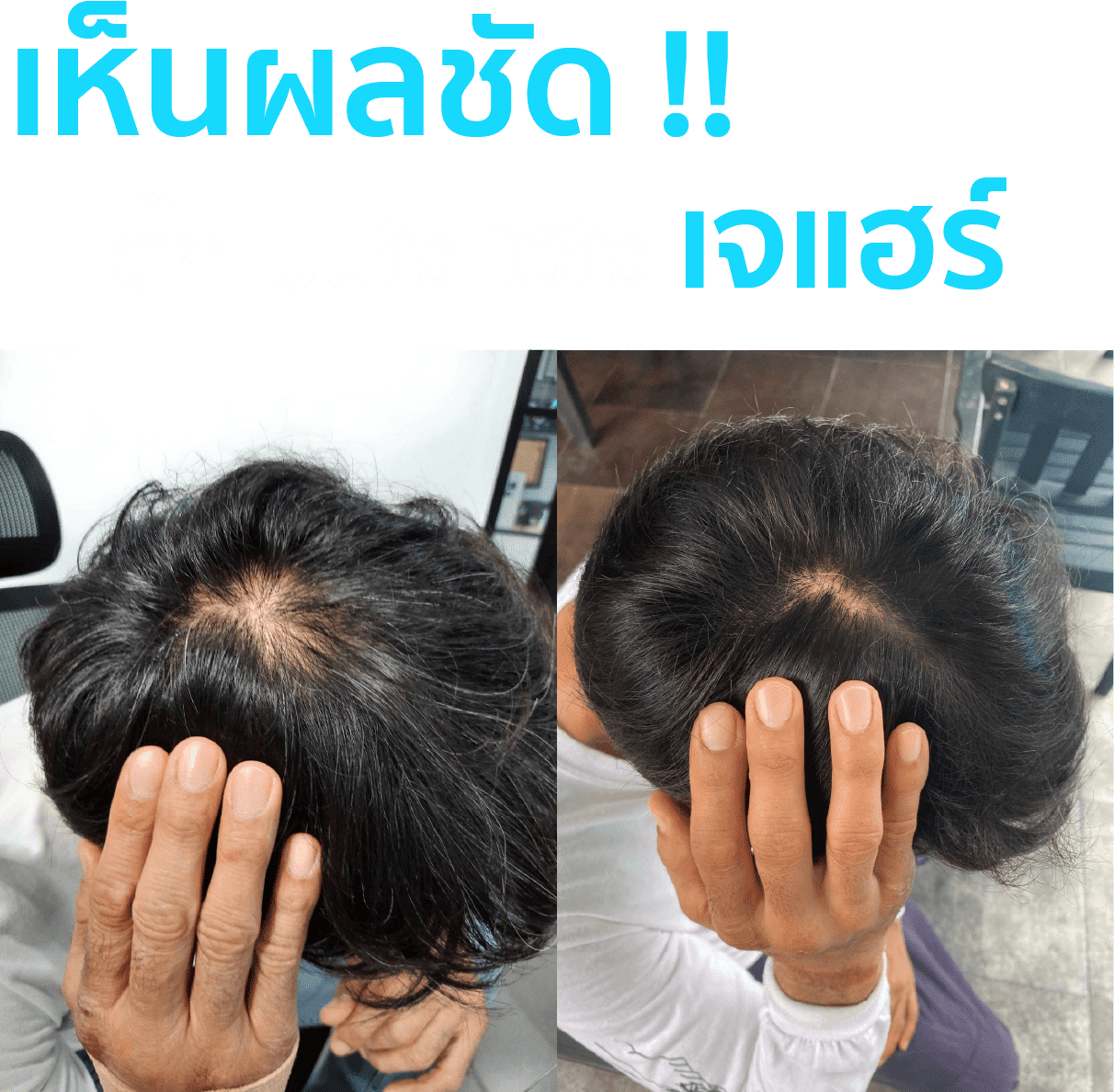 J HAIR Serum รีวิว จากคุณตั๊ก นภัสรัญชน์ มิตรธีรโรจน์