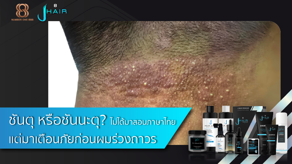 ชันตุ หรือชันนะตุ? ไม่ได้มาสอนภาษาไทย แต่มาเตือนภัยก่อนผมร่วงถาวร​