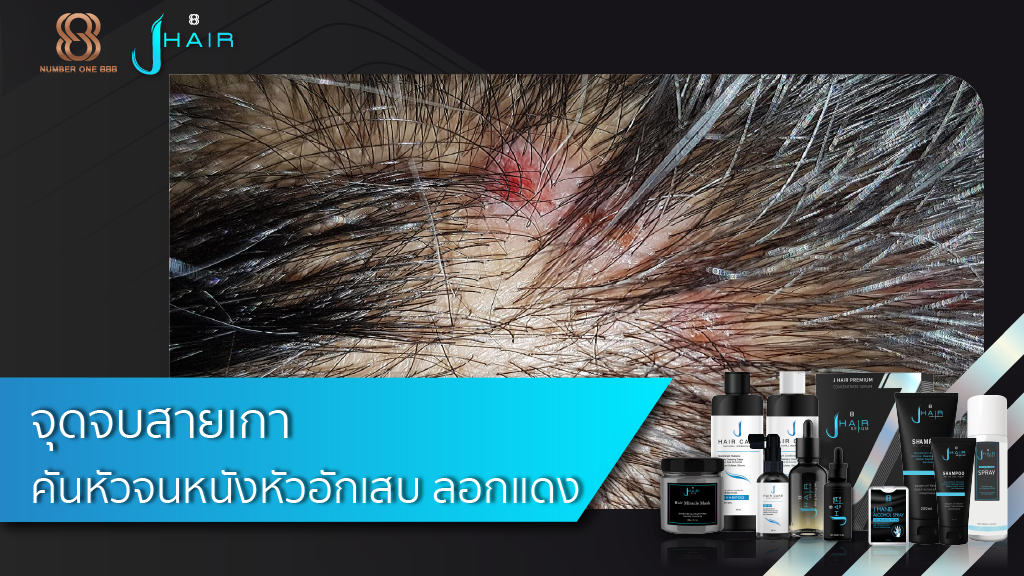 จุดจบสายเกา คันหัวจนหนังหัวอักเสบ ลอกแดง