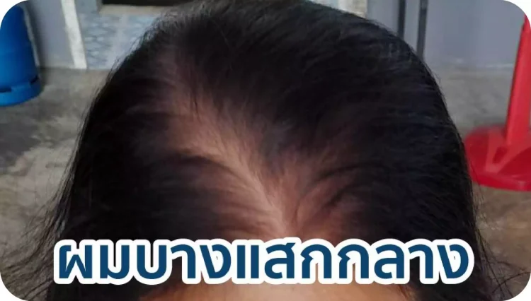 หนังศีรษะมีเลือดออก - 10 ผลข้างเคียงของการทำศัลยกรรมปลูกผมที่คุณควรรู้ - สาระน่ารู้จาก Jhair