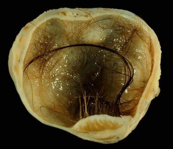 ซีสต์ (Cyst) หรือถุงน้ำ - 10 ผลข้างเคียงของการทำศัลยกรรมปลูกผมที่คุณควรรู้ - สาระน่ารู้จาก Jhair